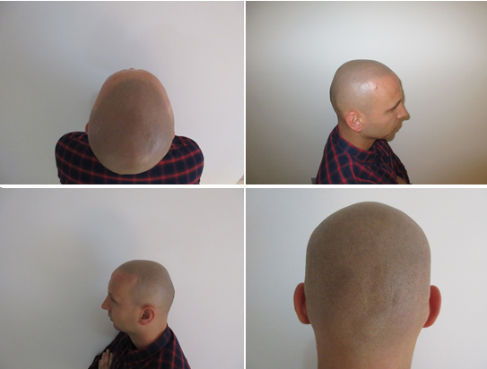 File:Scalp Micropigmentation Results.png - Wikimedia Commons